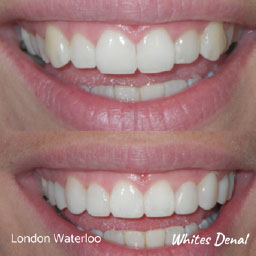 cosmetic dentist in london waterloo | Whites Dental