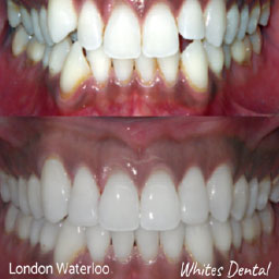 orthodontist in london waterloo | Whites Dental