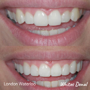 what are the pros and cons of veneers in london | Whites Dental