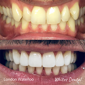 Orthodontic Braces & Invisalign In London | Whites Dental