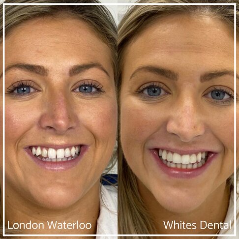 Full face images showing smile transformation with composite bonding.