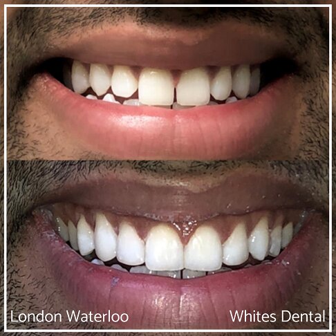 Close-up photos of a smile before and after composite bonding.