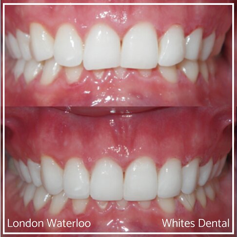 Close-up comparison of teeth showing composite bonding results.