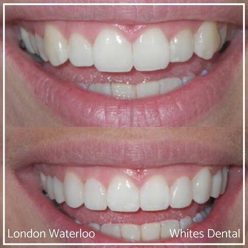 Close-up of teeth before and after composite bonding treatment.