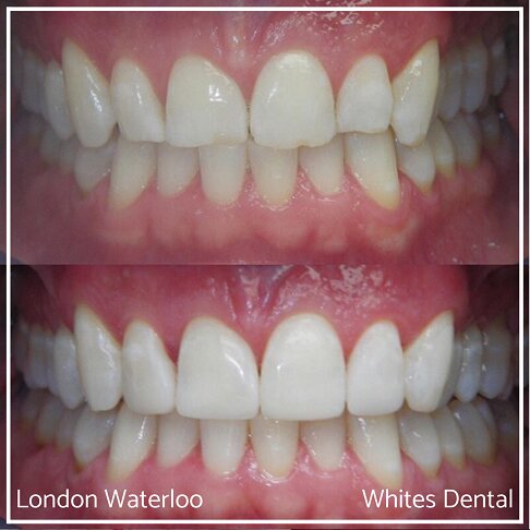 Close-up photos showing the effect of composite bonding on a smile.