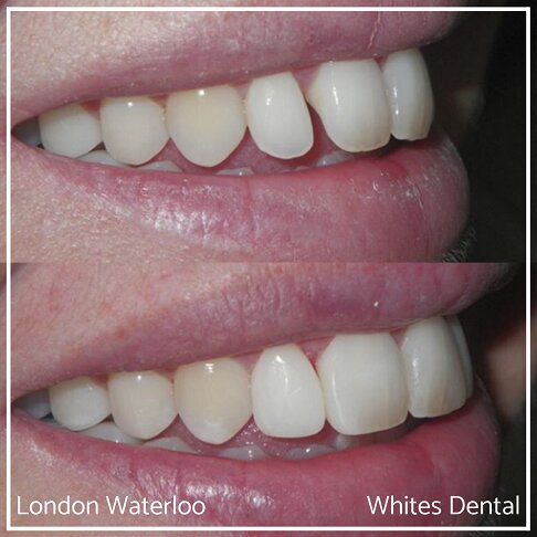 Before and after images of teeth enhanced through composite bonding.