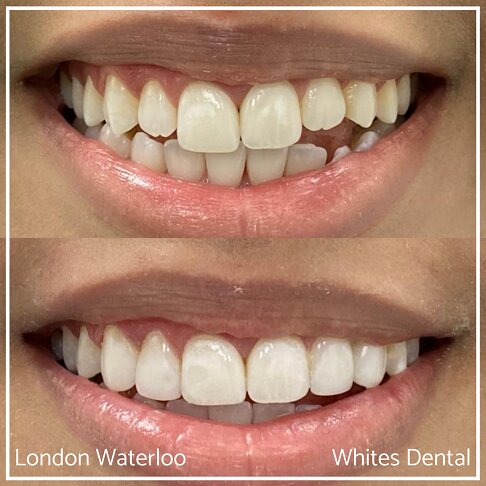 Close-up of a smile before and after composite bonding treatment.