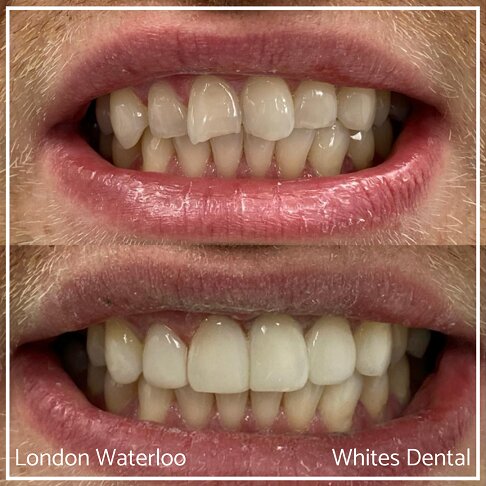 Close-up photos of teeth showing composite bonding transformation.