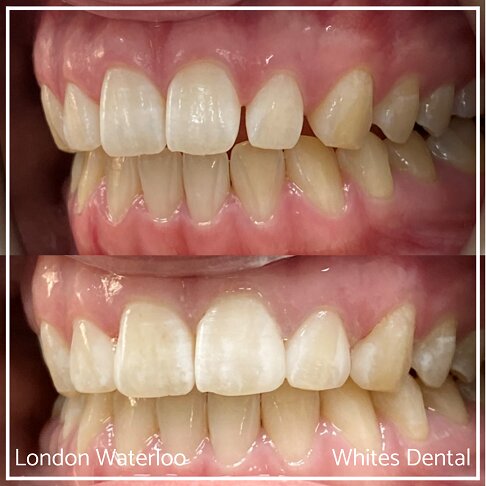 Detailed comparison of teeth before and after composite bonding.