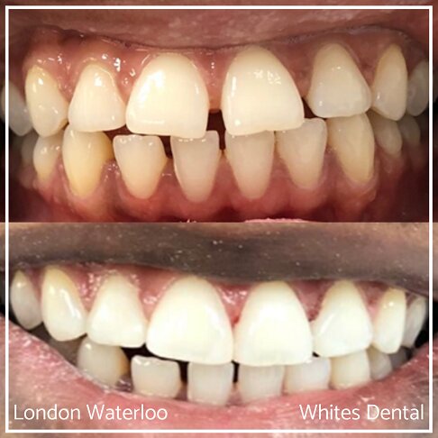 Close-up view of teeth before and after composite bonding treatment.