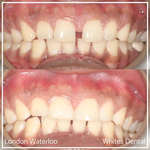 Before and after smile close-up showing composite bonding results.