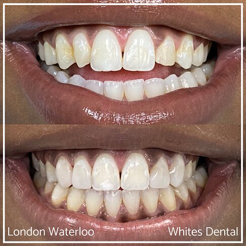 Close-up images of teeth showing composite bonding improvement.