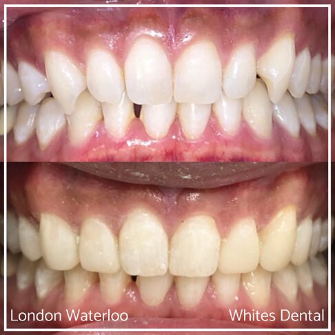 Side-by-side images of a smile before and after composite bonding.