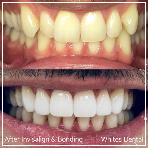 Close-up comparison of smile showing Invisalign and composite bonding results.