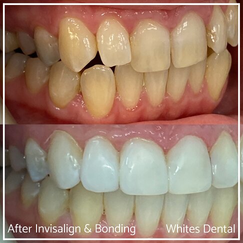 Before and after images of teeth enhanced by Invisalign and composite bonding.