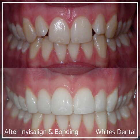 Mouth close-up showing the effect of Invisalign and composite bonding.