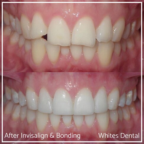 Detailed view of teeth before and after Invisalign and composite bonding.