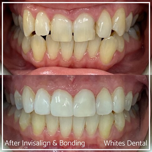 Close-up of mouth before and after Invisalign and composite bonding.