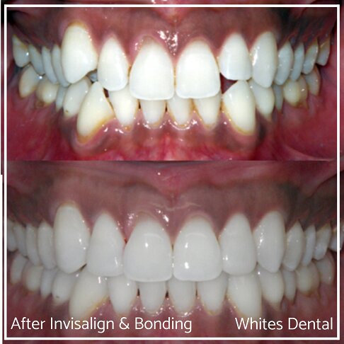 Close-up of smile showing Invisalign and composite bonding results.