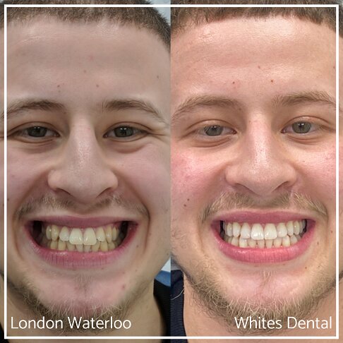 Full face comparison of smile before and after dental bonding.