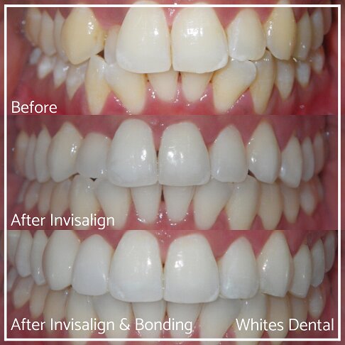 3 photo comparison of a smile transformations from before treatment, with Invisalign and Invisalign and bonding.