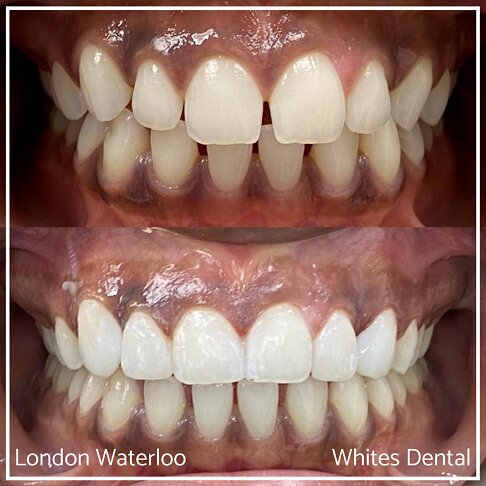 Close-up of teeth before and after composite bonding procedure.