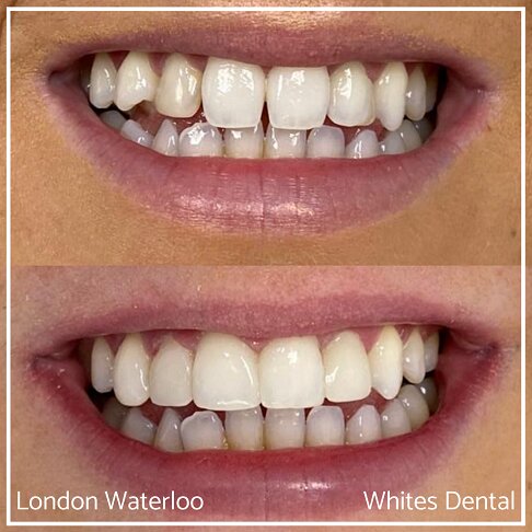 Close-up view of smile showing composite bonding improvement.