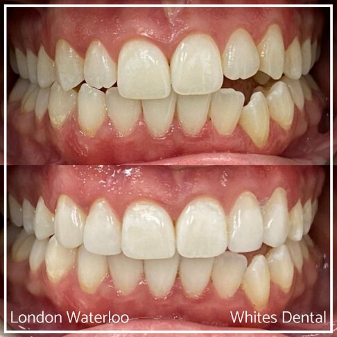 Close-up photos of teeth showing before and after composite bonding.