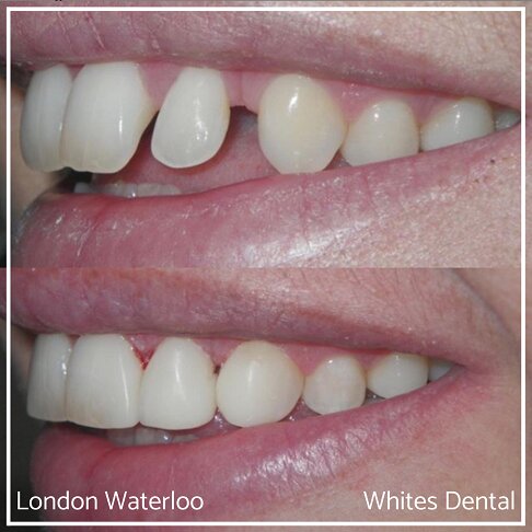 Close-up view of smile showing composite bonding results.