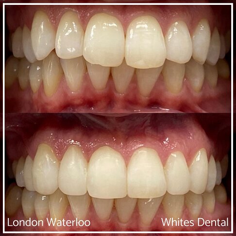 Close-up photos of teeth showing composite bonding improvement.