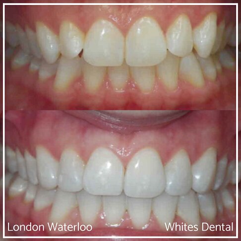 Close-up comparison of teeth before and after composite bonding.