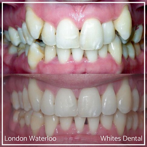 Invisalign Braces Before And After Orthodontist in London 2 | Whites Dental