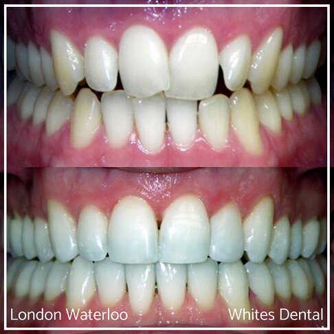 Invisalign Braces Before And After Orthodontist in London 3 | Whites Dental