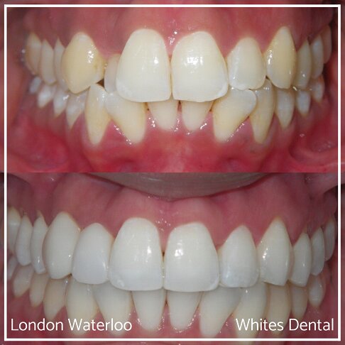 Invisalign Braces Before And After Orthodontist in London 4 | Whites Dental