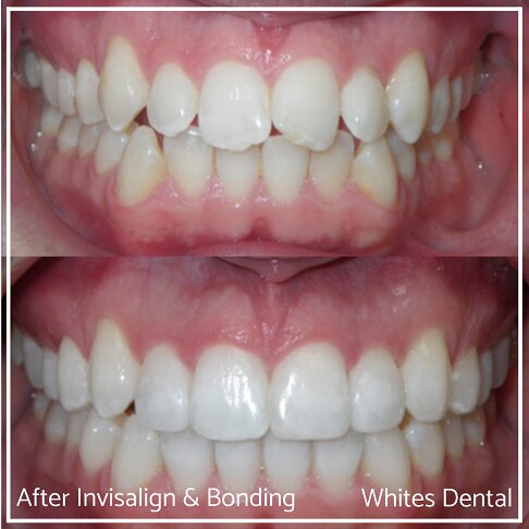 Invisalign Braces Before And After Orthodontist in London 5 | Whites Dental