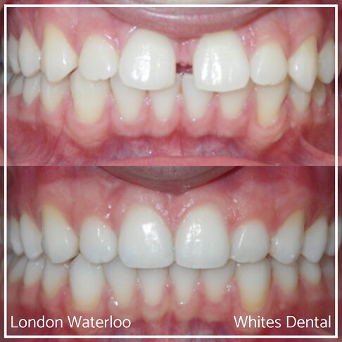 Invisalign Braces Before And After Orthodontist in London 6 | Whites Dental