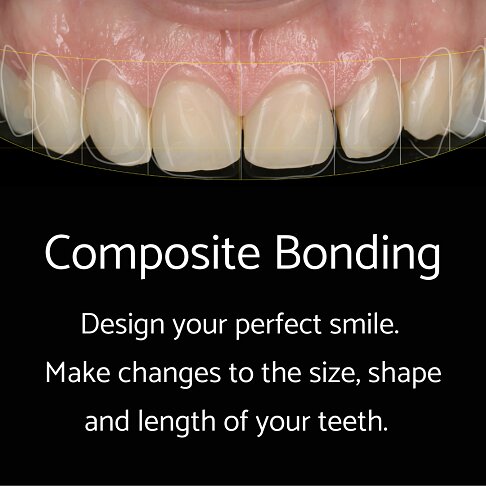 Composite bonding is used for smile makeovers in London