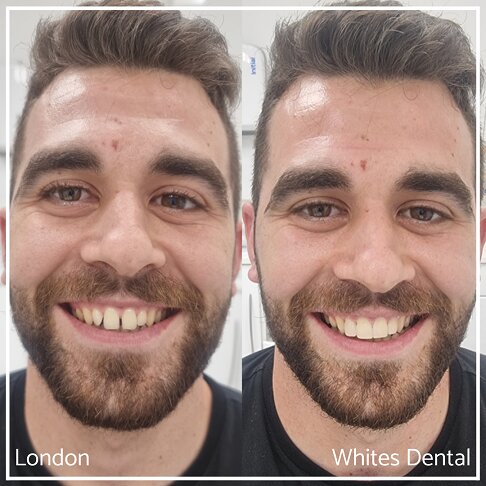 Comparison of full face before and after smile makeover.