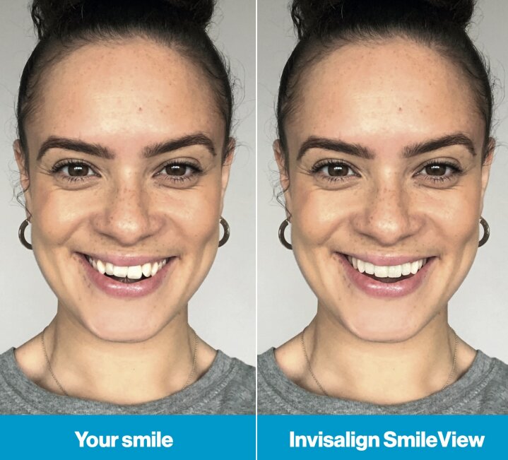 Invisalign Before And After Smile Simulation Mobile | Whites Dental