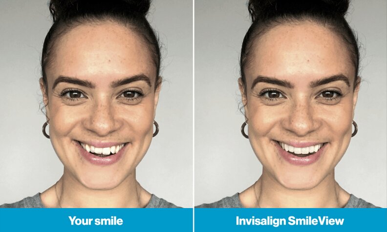 Invisalign Before And After Smile Simulation, Book a Free Consultation Today