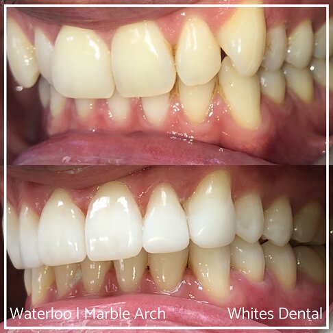 Successful Invisalign Overcrowding Before and After Results in London Waterloo and Marble Arch - Case Study 27