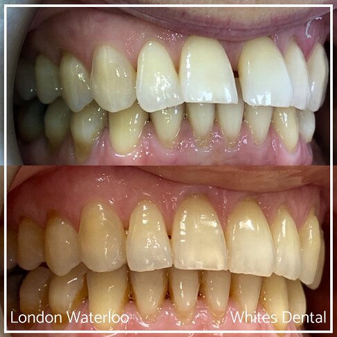 Successful Invisalign Teeth Gap Before and After Results in London Waterloo and Marble Arch - Case Study 1