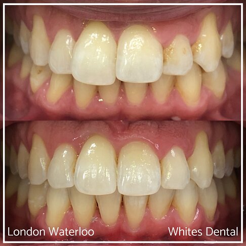 Successful Invisalign Overbite and Underbite Before and After Results in London Waterloo and Marble Arch - Case Study 1