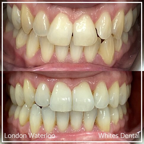 Successful Invisalign Overcrowding Before and After Results in London Waterloo and Marble Arch - Case Study 10