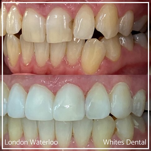 Successful Invisalign Teeth Gap Before and After Results in London Waterloo and Marble Arch - Case Study 12