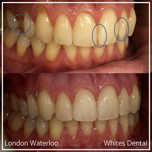 Successful Invisalign Overcrowding Before and After Results in London Waterloo and Marble Arch - Case Study 12