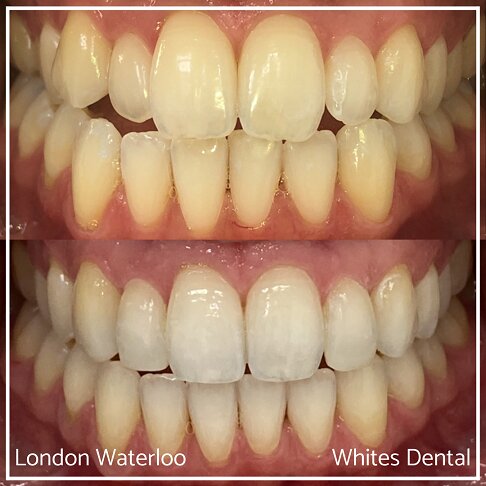 Successful Invisalign Overcrowding Before and After Results in London Waterloo and Marble Arch - Case Study 13