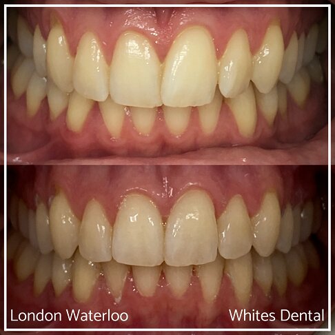 Successful Invisalign Overcrowding Before and After Results in London Waterloo and Marble Arch - Case Study 14