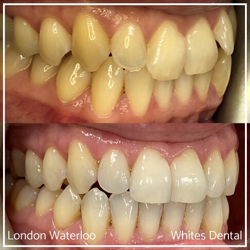 Successful Invisalign Worst Cases Before and After Results in London Waterloo and Marble Arch - Case Study 14