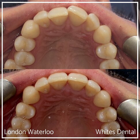 Successful Invisalign Overcrowding Before and After Results in London Waterloo and Marble Arch - Case Study 15